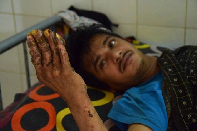 Bangladesh ‘Tree Man’ returns to hospital as condition worsens