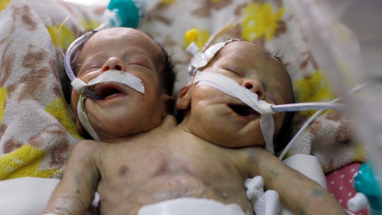 Yemeni conjoined twins die without treatment abroad