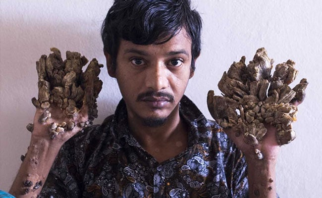 Bangladesh 'Tree Man' Wants Hands Amputated To Relieve Pain