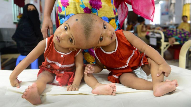 'Stable After Final Separation': Doctors On Conjoined Bangladeshi Twins