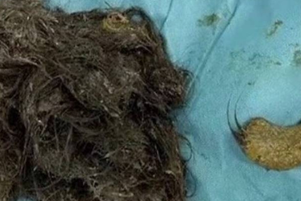 Three kilos of hair within a 14 year old girl's stomach !